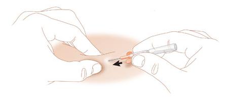 Nursing guideline subcut devices insuflon insertion2